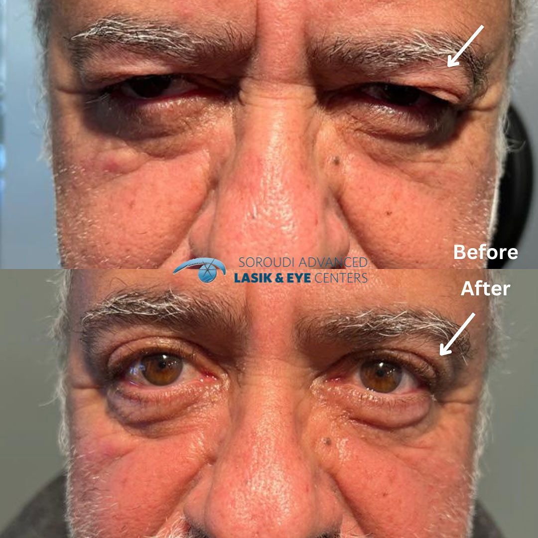 Blepharoplasty (Eyelid Surgery) After - Male Patient by Dr. Soroudi - Los Angeles, Beverly Hills, Newport Beach & Glendale