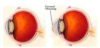 Detailed 360-degree scan of eye lens for diagnosis – Soroudi Advanced LASIK & Eye Centers Los Angeles