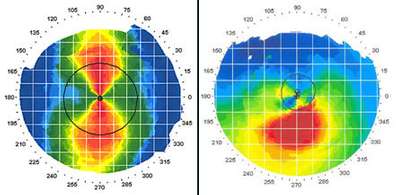 360-degree diagnostic machine view of eye lens – Soroudi Advanced LASIK & Eye Centers Los Angeles