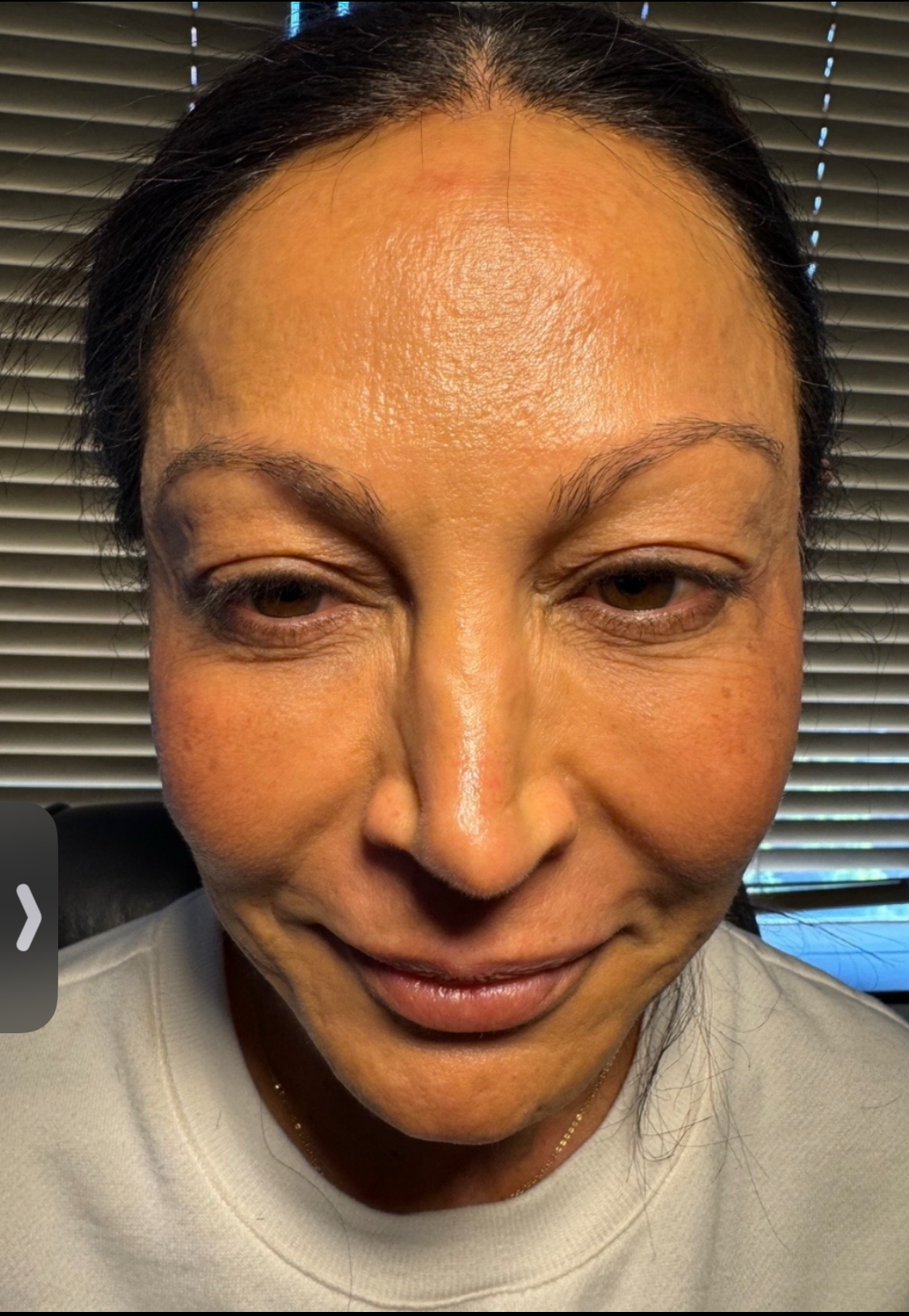 blepharoplasty eyelid surgery