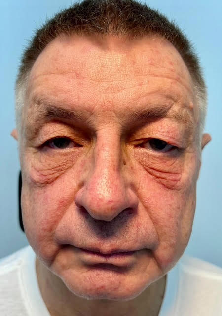 blepharoplasty eyelid surgery