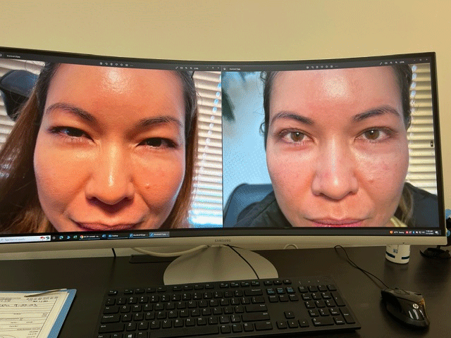 Blepharoplasty (Eyelid Surgery) 