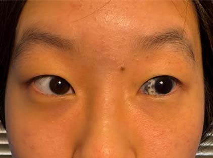Close-up of girl’s eye with black spots visible – Soroudi Advanced LASIK & Eye Centers Los Angeles