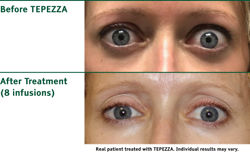 Before and after eye images showing Tepezza treatment results – Soroudi Advanced LASIK & Eye Centers Los Angeles