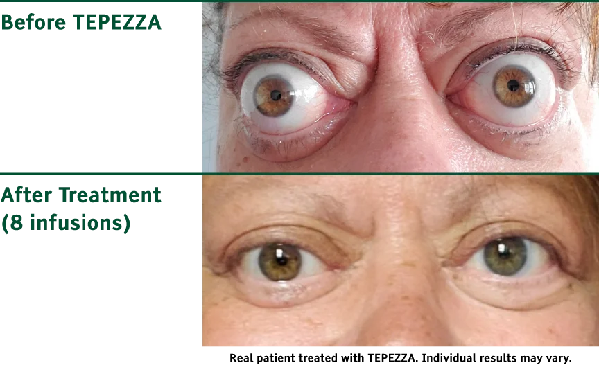 Old man’s eyes before and after severe Tepezza treatment – Soroudi Advanced LASIK & Eye Centers Los Angeles 