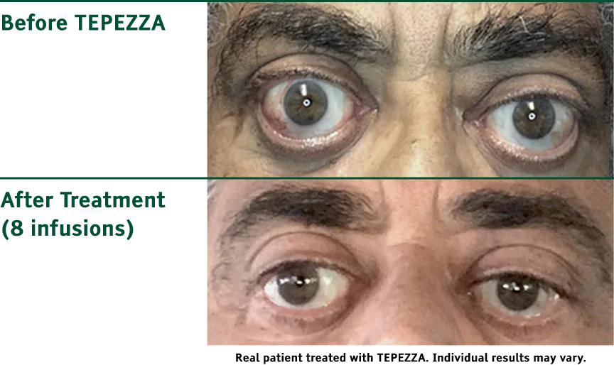 Older man’s eyes before and after Tepezza treatment – Soroudi Advanced LASIK & Eye Centers Los Angeles